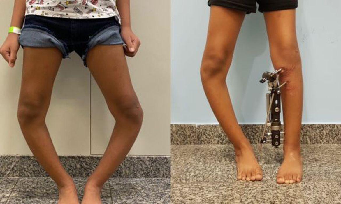 Técnica inovadora corrige deformidades nas pernas de crianças e jovens