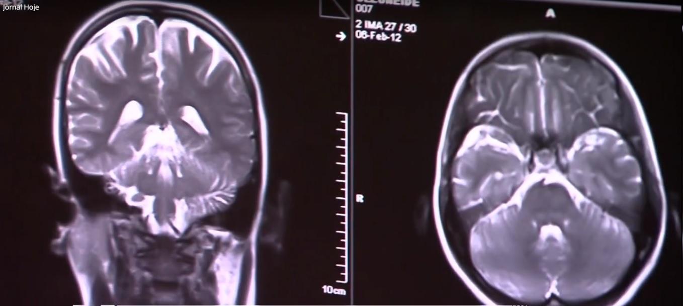 Novo remédio contra Alzheimer é aprovado nos EUA