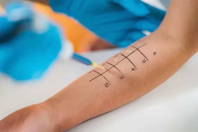 Veja porque você deve fazer o teste de alergia gratuito no Rio de Janeiro e Baixada Fluminense