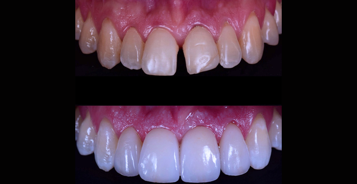 Lentes de contato dental podem ser aplicadas em restaurações 