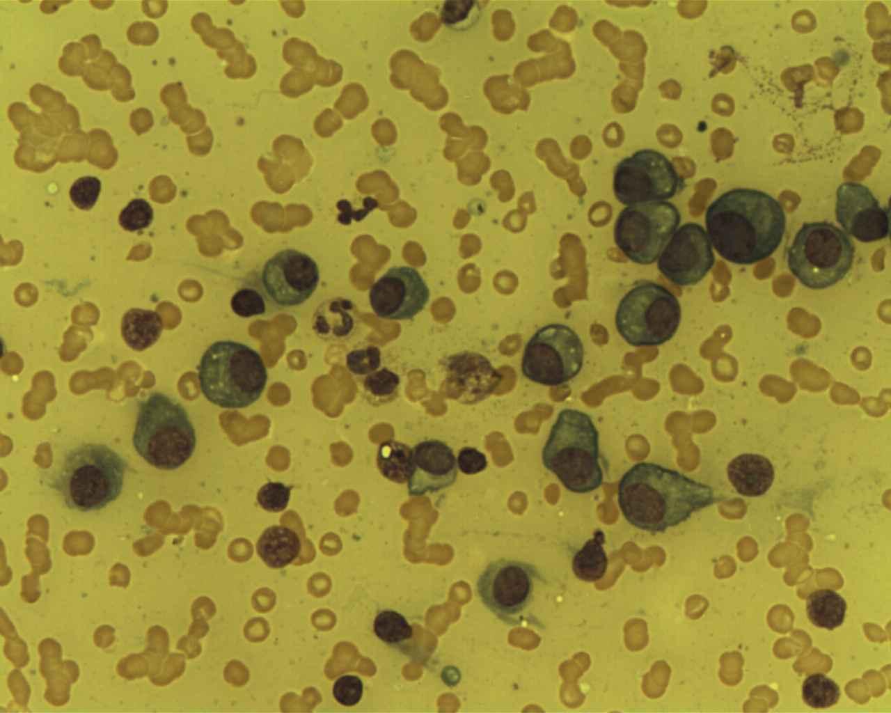 Projeto busca cortar pela metade custo de tratamento para tipo de câncer no sangue