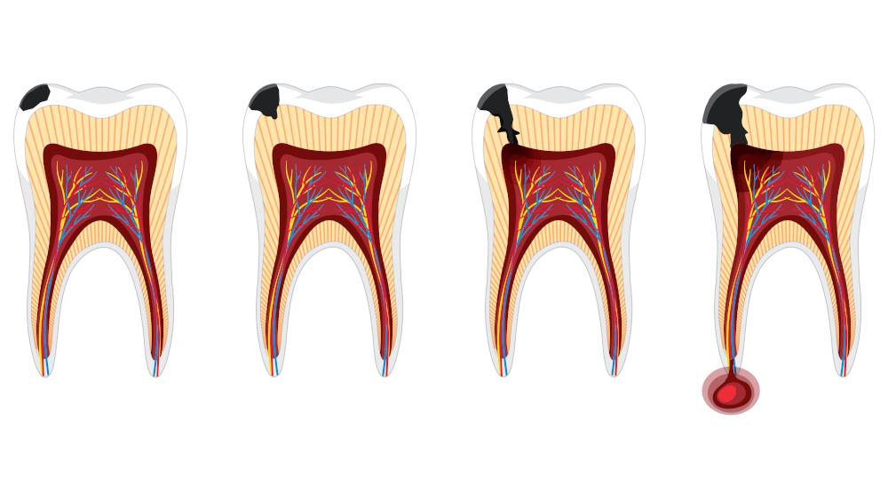 Combinação de exercício físico e ômega-3 reduz gravidade de infecção na raiz do dente