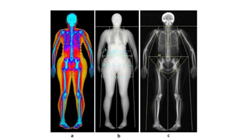 Gordura abdominal está ligada a maior risco de perda urinária em mulheres