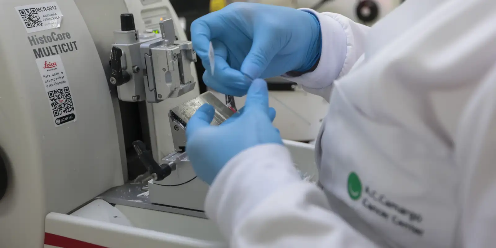 SUS incorpora novo tratamento para leucemia mieloide aguda em adultos