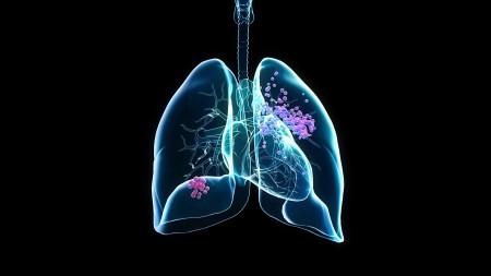 Biomarcadores no sangue ajudam a prever eficácia de imunoterapia contra câncer de pulmão