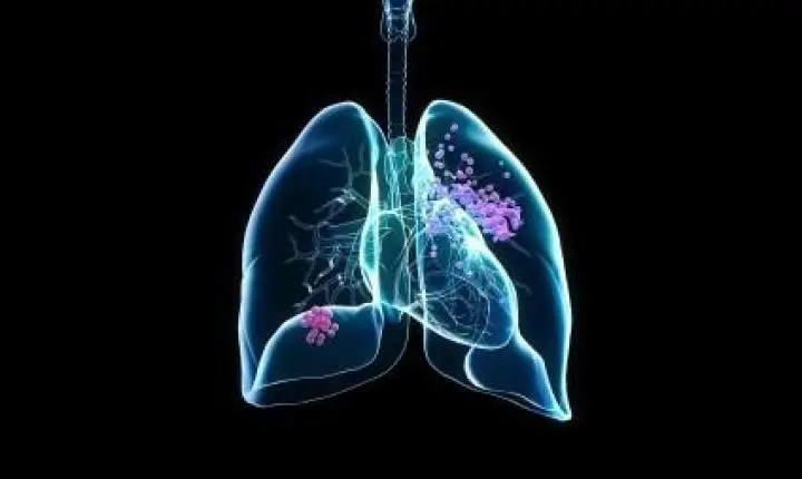 Biomarcadores no sangue ajudam a prever eficácia de imunoterapia contra câncer de pulmão
