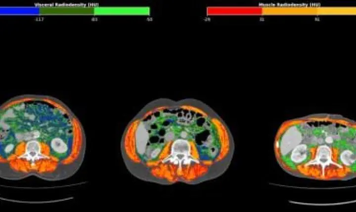 Marcador inédito usa tomografia para refinar prognóstico no câncer de estômago