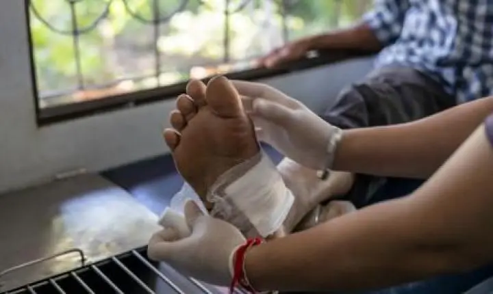 Nanopartícula combina duas estratégias para acelerar a cicatrização de feridas crônicas